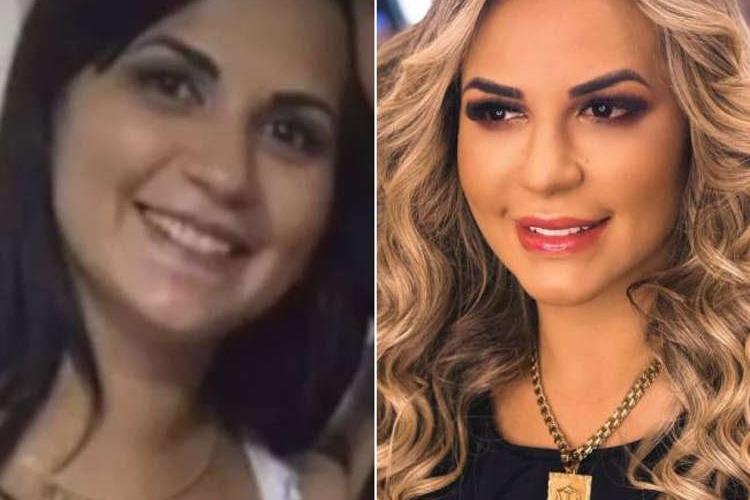 Antes e depois: Deolane Bezerra abre o jogo sobre cirurgias