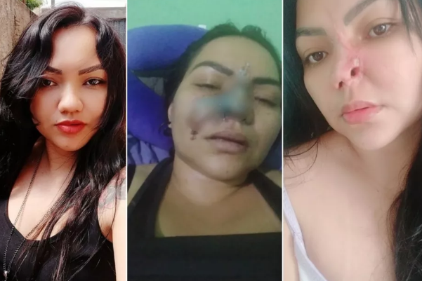 Mulher perde parte do nariz após cirurgia estética: “É assustador