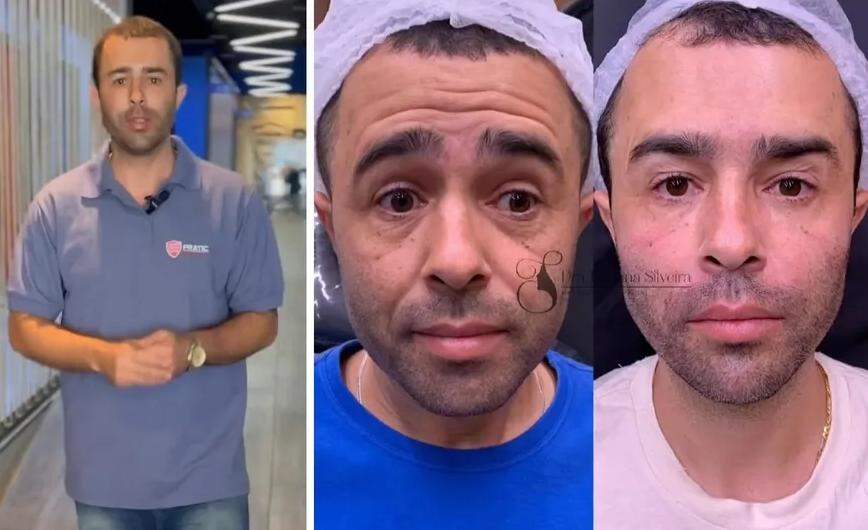 Influencer Bruno Diferente faz harmonização facial e surpreende